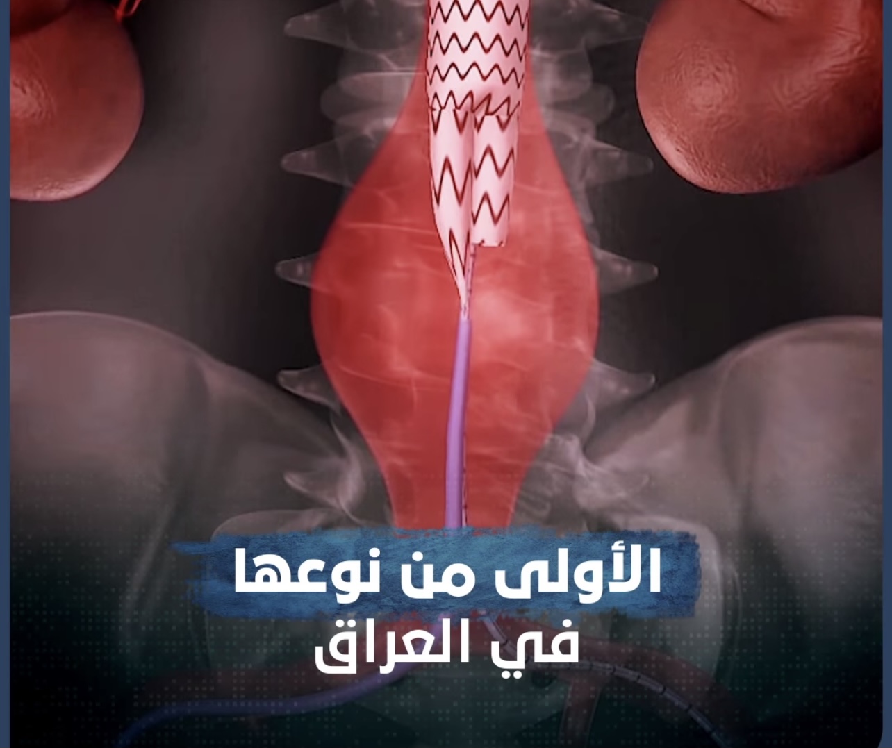 نجاح أطباء عراقيون باستخدام تقنية جديدة لمعالجة مرض “أم الدم”